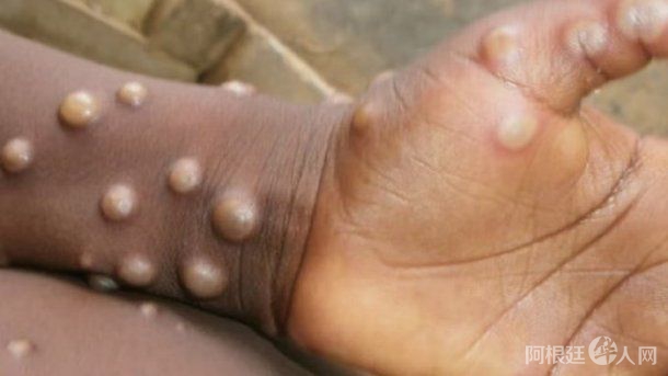 viruela-del-mono viruela-del-mono