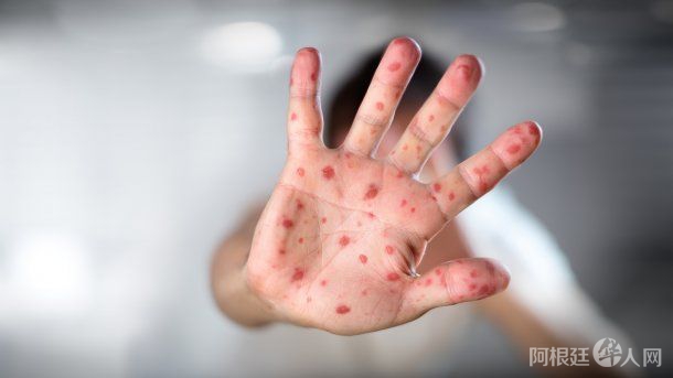 viruela-del-monojpeg