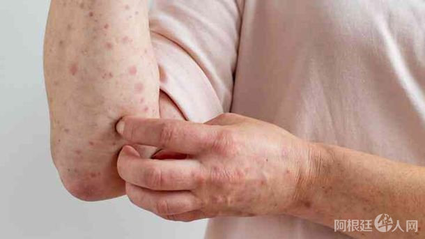 viruela-del-mono-2jpg viruela-del-mono-2jpg